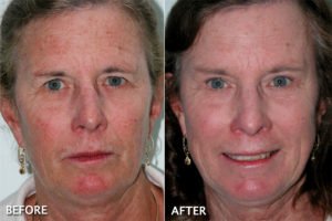 brow lift before and after - real patient - front view - large