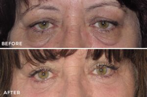 eyelid surgery before and after - patient 006 - front view