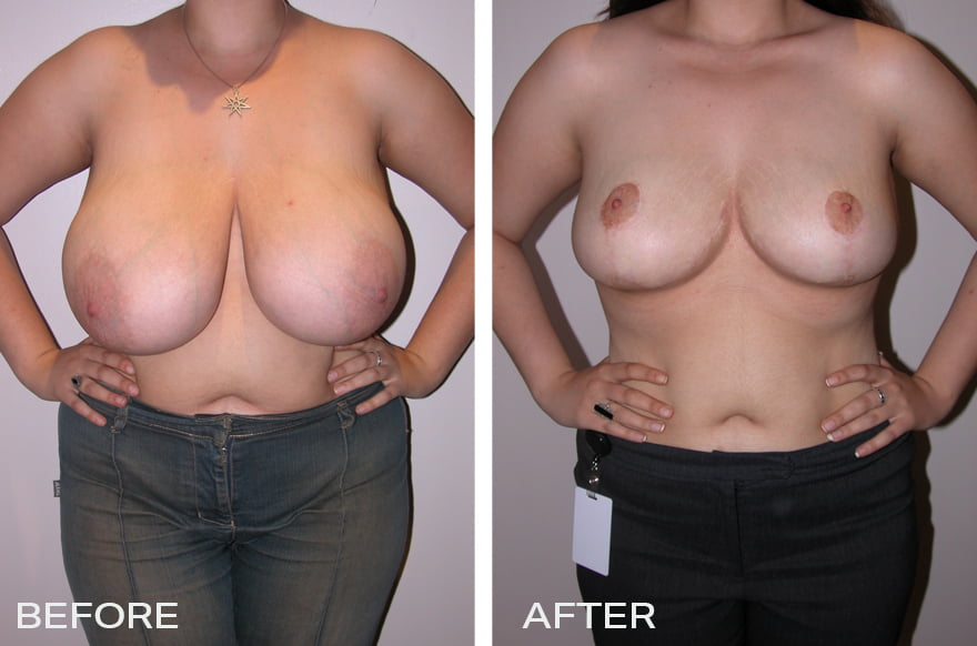 Breast Reduction Before and After