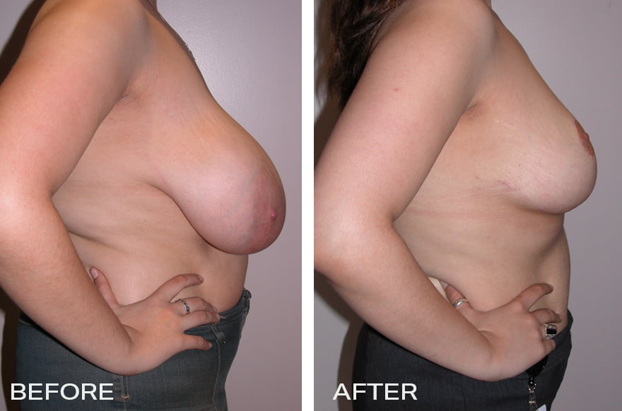 Large Breast Surgery - Breast Reduction Surgery Image Sideview