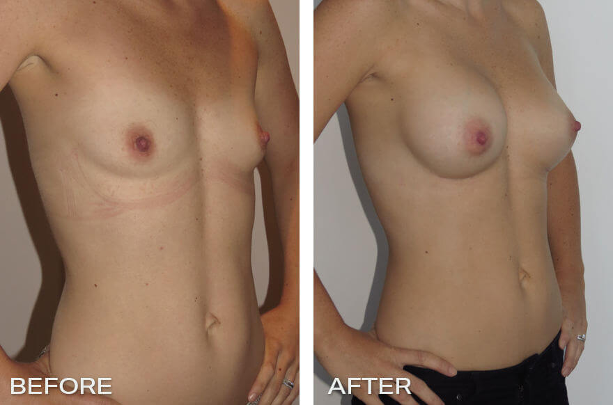 Case Study of Breast Augmentation Mammoplasty # 1 2 Before and After Front - Case Study of Breast Enlargement