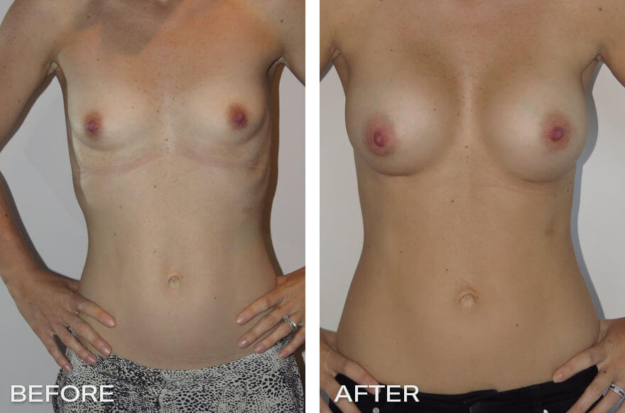Case Study of Breast Augmentation Mammoplasty # 1 1 Breast Enlargement Surgery Before and After Front