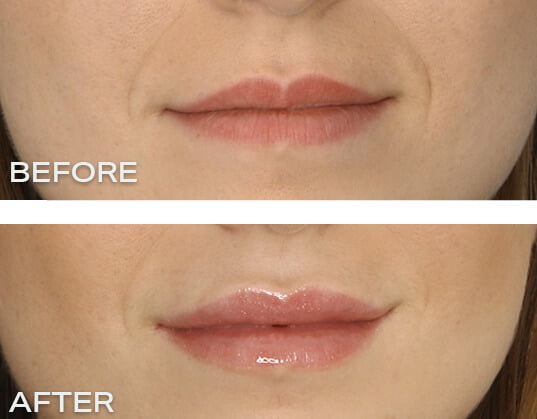 filler 2 1 Things to Avoid after Lip Injections – The Dos & Don’ts of Lip Injections - 2