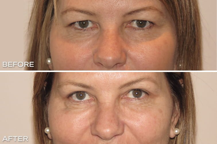 Fixing Hooded Eyelids Before and After Dr Hunt Sydney