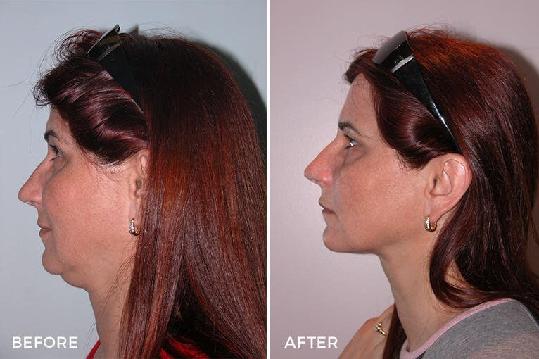 Case Study of Neck Liposuction #1 17 Neck Liposuction Before and After by Dr Jeremy Hunt - Case Study of Heavy Neck