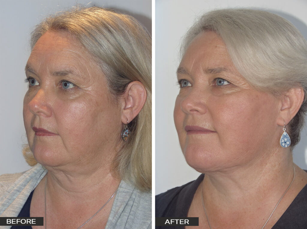 before and after neck lift or lower facelift - Dr Jeremy Hunt Leading Plastic Surgeon Sydney NSW