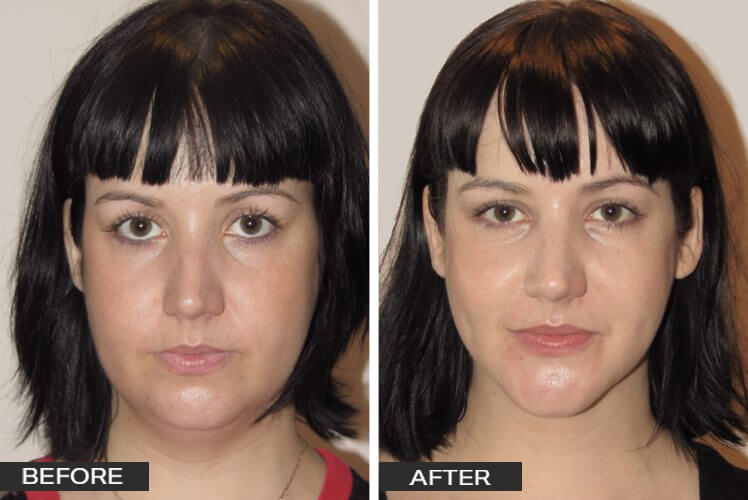 Chin Surgery - Dr Jeremy Hunt Best Chin Surgeon Sydney