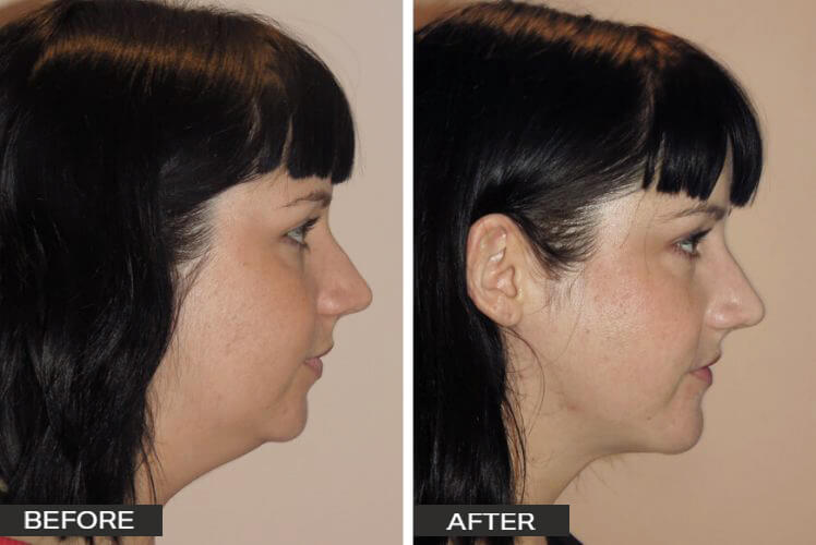 Chin Surgery Case Studies Dr Jeremy Hunt - Chin-surgery-and-lipo_2-side-2-e1590625451529_edited