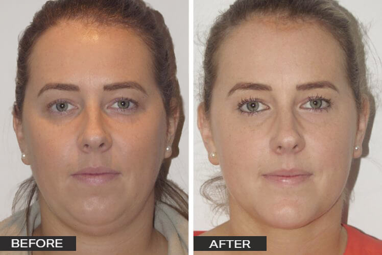 Chin Surgery Case Studies Dr Jeremy Hunt - Chin1-e1590625627545_edited