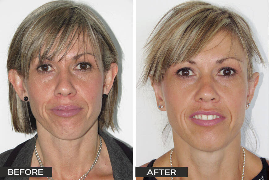 Ear Surgery Otoplasty Case Study 6 Ear Surgery by Dr Jeremy Hunt Before and After Image Ear Surgery 14 Edited Scaled