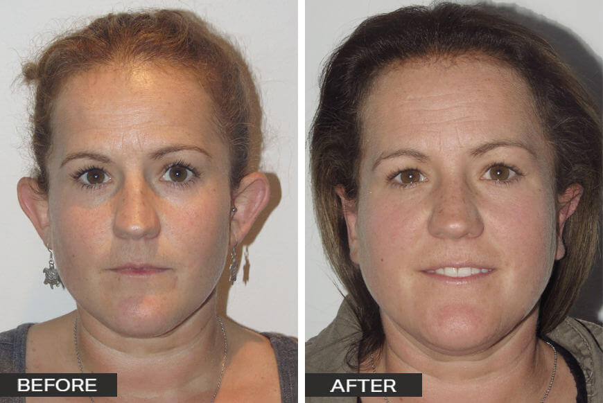 Ear Surgery Otoplasty Case Study 7 Ear Surgery by Dr Jeremy Hunt Before and After Image Ear Surgery 5 Front Scaled