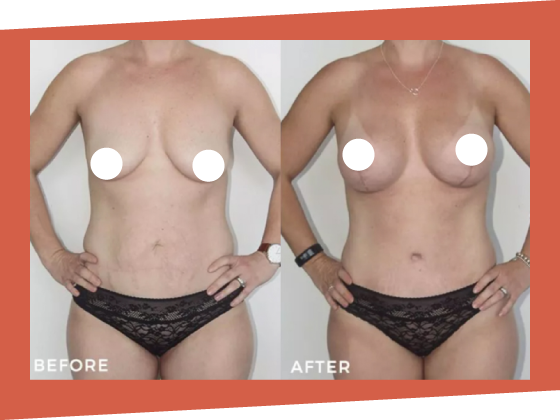 mummy makeover before after