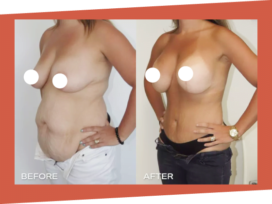 mummy makeover before after