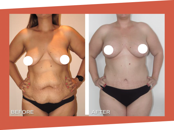mummy makeover before after