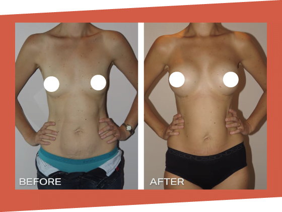 mummy makeover before after