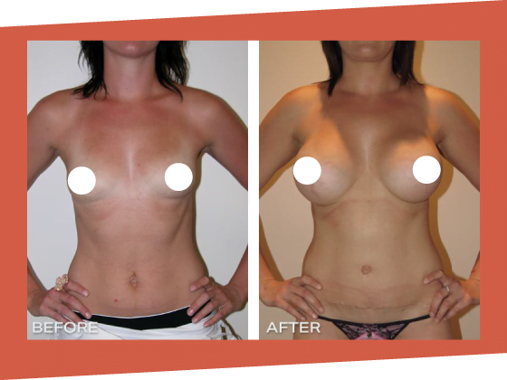 mummy makeover before after