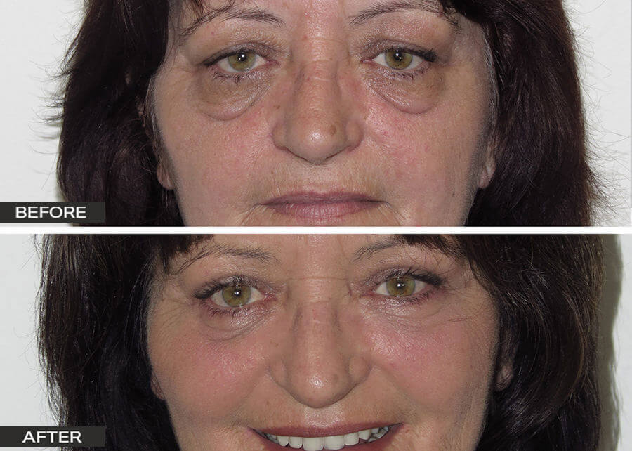 Blepharoplasty Eyelid Surgery by Dr Jeremy Hunt - Eyelid Rejuvenation options