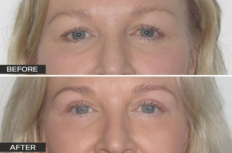 Blepharoplasty Eyelid Surgery by Dr Jeremy Hunt - Eyelid Rejuvenation options