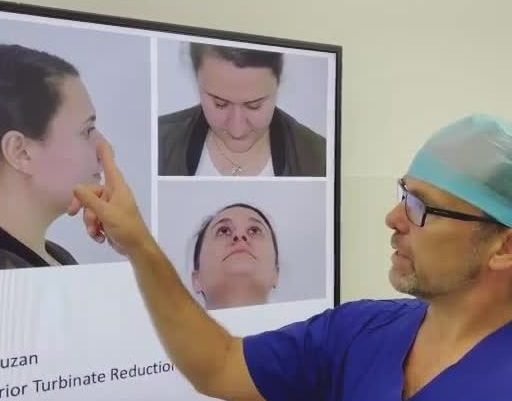 best nose surgery sydney - best nose surgeon sydney