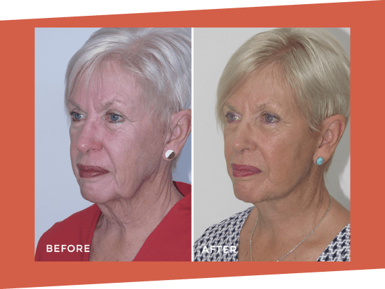 1 - LP Facelift OMD LP 35 Facelift Dr Jeremy Hunt Before and After Photo - Facelift BA 2 Scaled