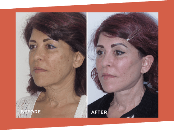 1 - LP Facelift OMD LP 33 Facelift Dr Jeremy Hunt Before and After Photo - Facelift BA 4 Scaled