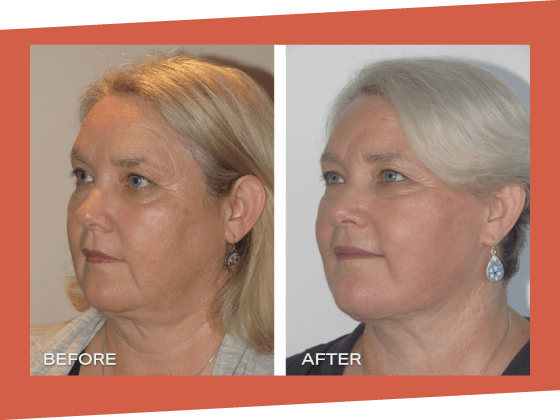 1 - LP Facelift OMD LP 32 Facelift Dr Jeremy Hunt Before and After Photo - Facelift BA 6 Scaled