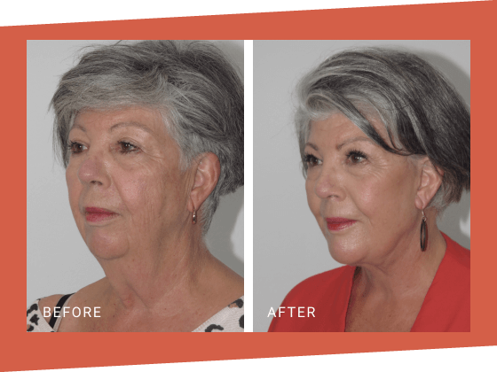 1 - LP Facelift OMD LP 31 Facelift Dr Jeremy Hunt Before and After Photo - Group 1 Scaled