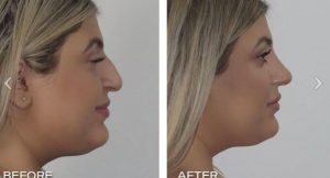 fleshy - Dr Jeremy Hunt Leading face surgeon