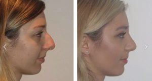 Different Nose Shapes - Combo Nose - Dr Jeremy Hunt Leading face surgeon