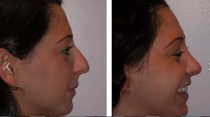 Nixon Nose types - Dr Jeremy Hunt Leading face surgeon