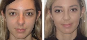 Different Nose Shapes - Dr Jeremy Hunt Leading face surgeon