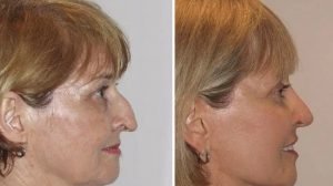 hawk nose types sydney - Dr Jeremy Hunt Leading face surgeon