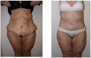 butt augmentation - empty buttlock syndrome - Dr Hunt