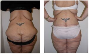 butt augmentation - empty buttlock syndrome - Dr Hunt