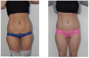 Body Lif with Butt Augmentation Dr Hunt