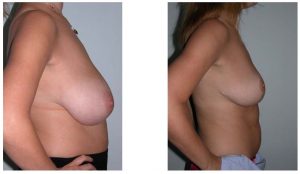 internal bra - How is it performed - Dr Hunt Sydney
