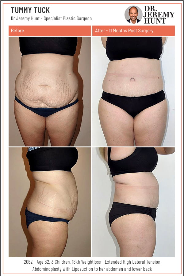 before-and-after-tummy-tuck-abdominoplasty_Dr-Jeremy-Hunt_Top-plastic-surgeon_Sydney
