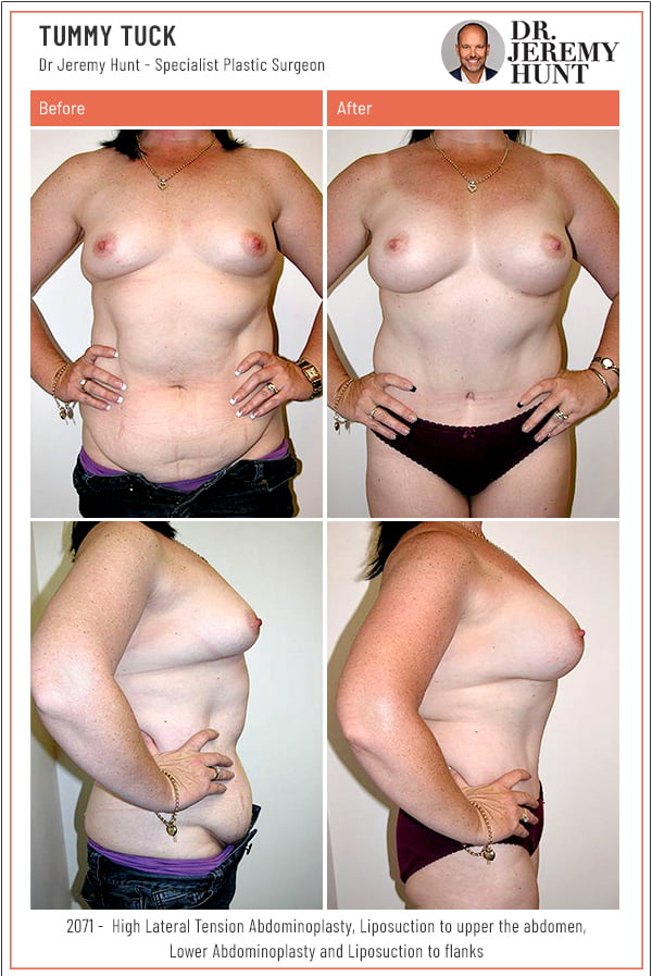 2071_tummy tuck_dr jeremy hunt