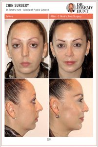 Chin Reduction Surgery Before-and-After_Chin-Surgery_Dr-Jeremy-Hunt_Top-Plastic-Surgeon_Sydney