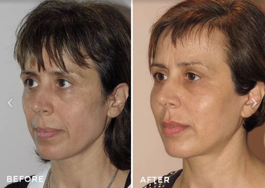 Mini facelift surgery