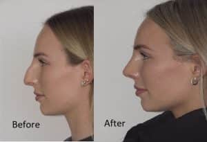 High Nasal Dorsum Nasal Dorsum Surgery – Rhinoplasty to Correct the Nose Bridge - 1