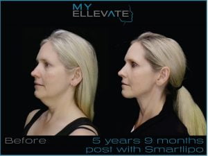 myellevate benefits Light-Guided Neck Sutures For Excess Neck Skin – Introducing MyEllevate - 4